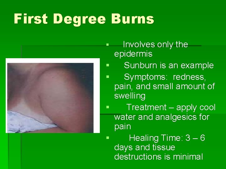 First Degree Burns § § § Involves only the epidermis Sunburn is an example