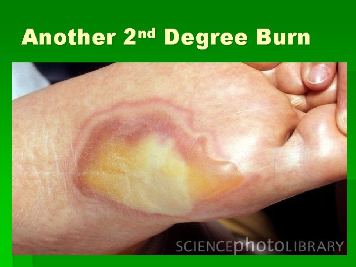 Another 2 nd Degree Burn 