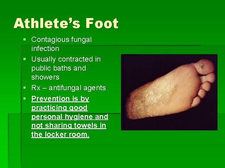 Athlete’s Foot § Contagious fungal infection § Usually contracted in public baths and showers