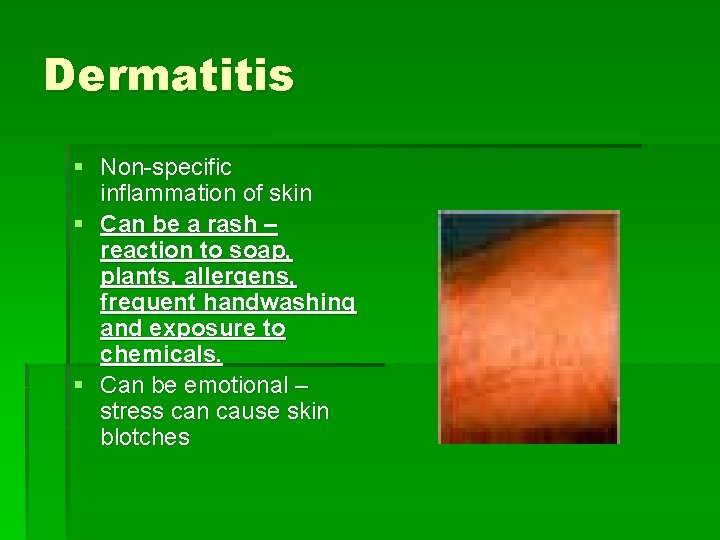 Dermatitis § Non-specific inflammation of skin § Can be a rash – reaction to