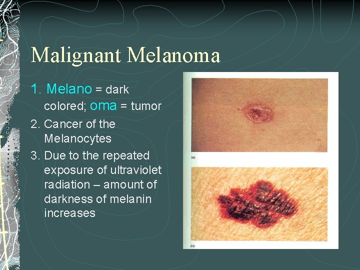 Malignant Melanoma 1. Melano = dark colored; oma = tumor 2. Cancer of the