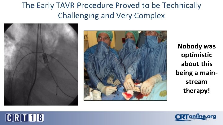 The Early TAVR Procedure Proved to be Technically Challenging and Very Complex Nobody was The Early TAVR Procedure Proved to be Technically Challenging and Very Complex Nobody was