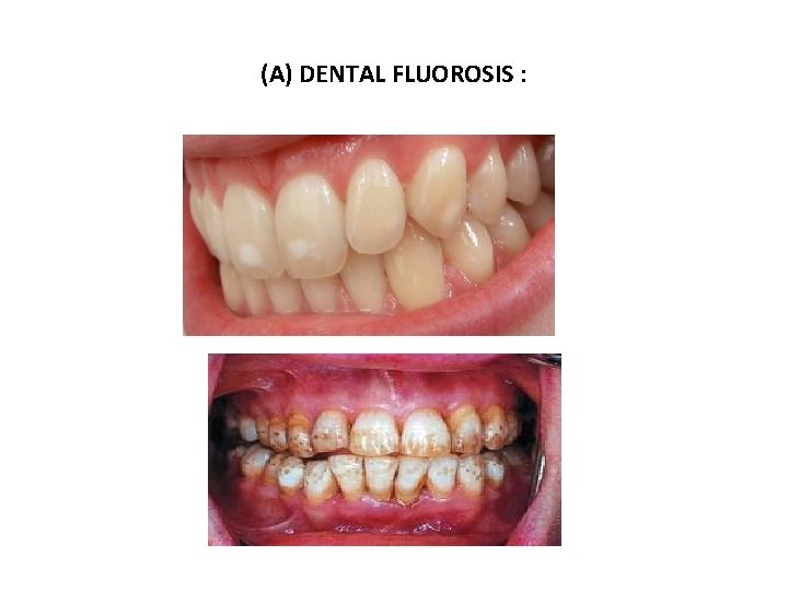 (A) DENTAL FLUOROSIS : 