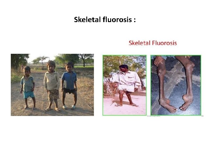 Skeletal fluorosis : 