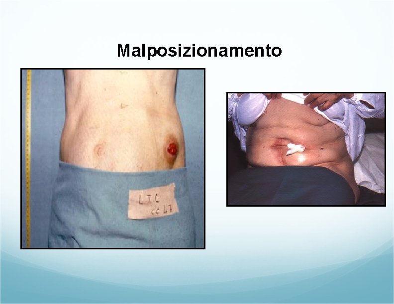 Malposizionamento Malposizionamento