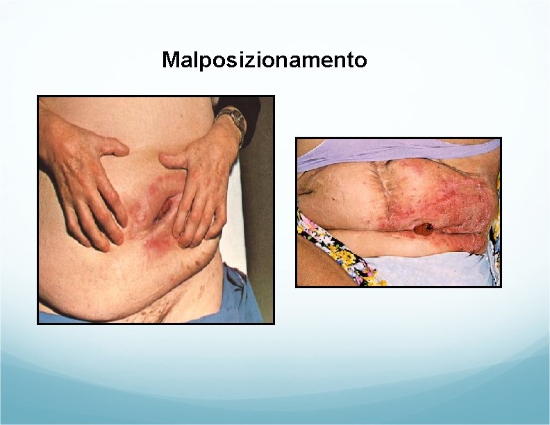 Malposizionamento Malposizionamento