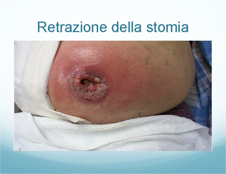 Retrazione della stomia Retrazione della stomia