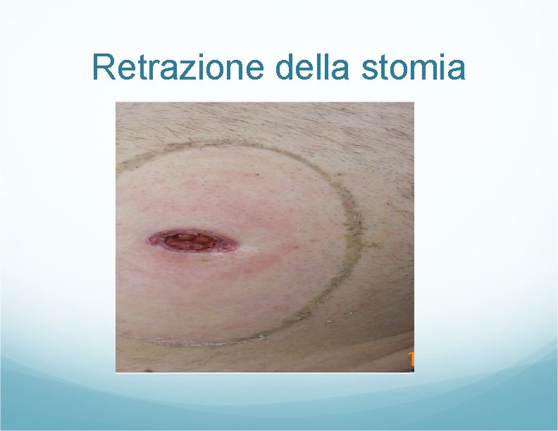 Retrazione della stomia Retrazione della stomia