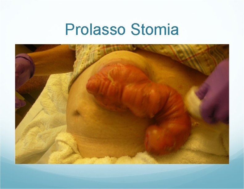 Prolasso Stomia Prolasso Stomia