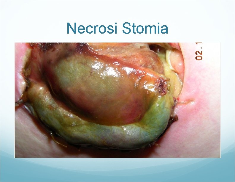 Necrosi Stomia Necrosi Stomia