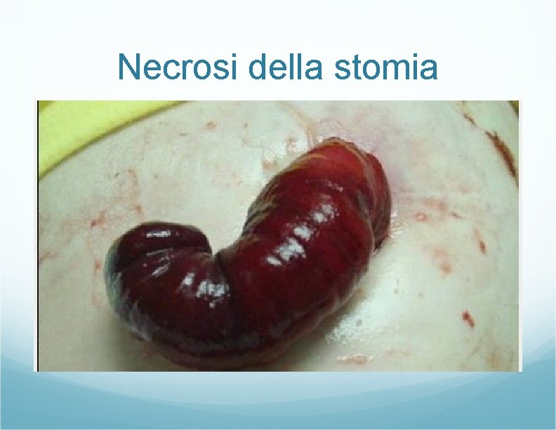 Necrosi della stomia Necrosi della stomia