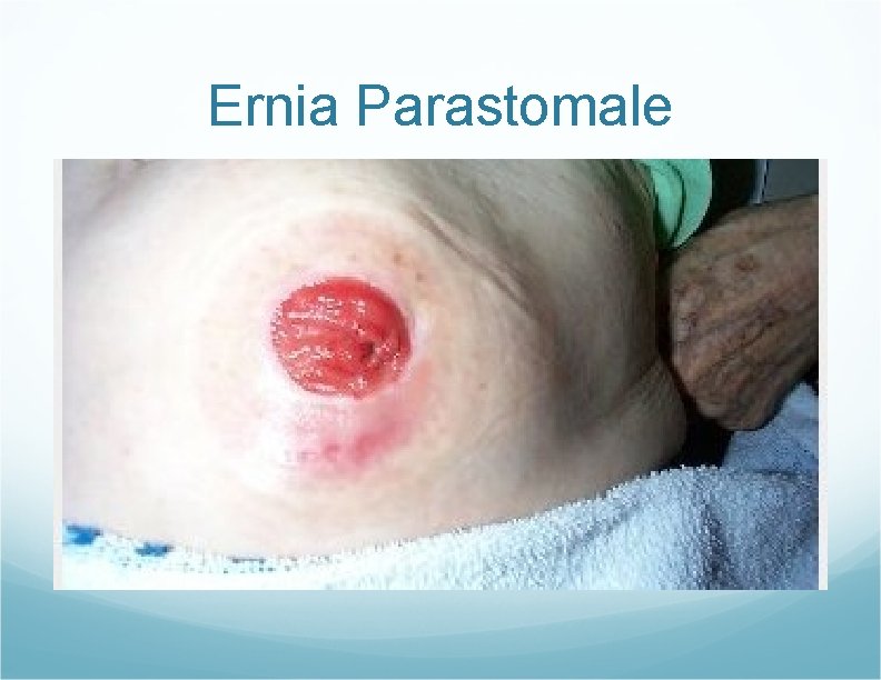 Ernia Parastomale Ernia Parastomale