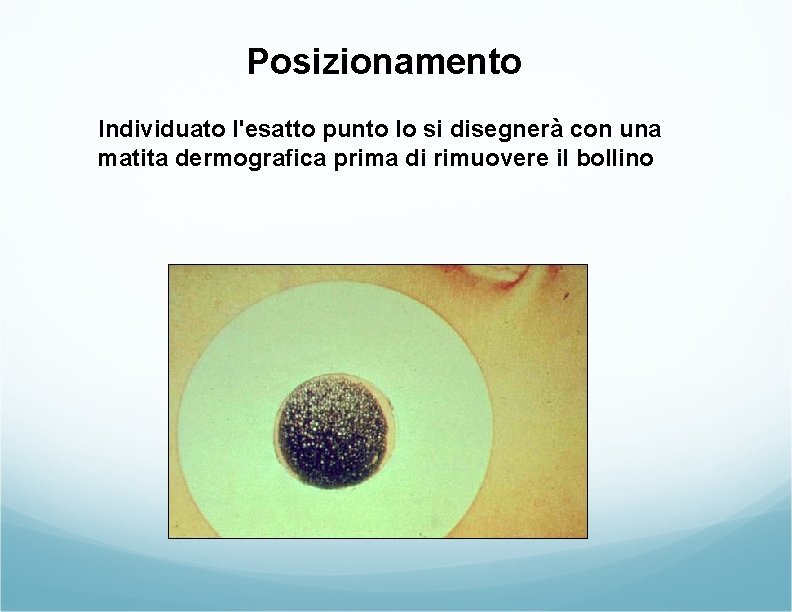 Posizionamento Individuato l'esatto punto lo si disegnerà con una matita dermografica prima di rimuovere Posizionamento Individuato l'esatto punto lo si disegnerà con una matita dermografica prima di rimuovere