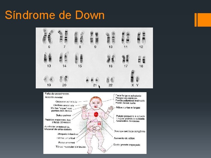 Síndrome de Down 