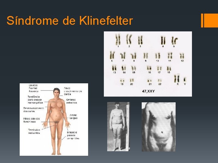 Síndrome de Klinefelter 