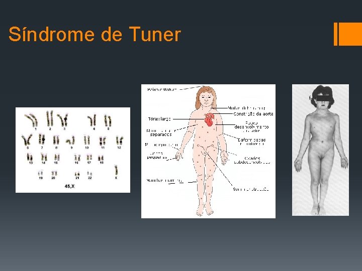 Síndrome de Tuner 