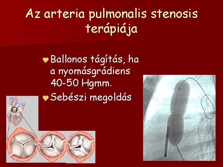 Az arteria pulmonalis stenosis terápiája Y Ballonos tágítás, ha a nyomásgrádiens 40 -50 Hgmm.