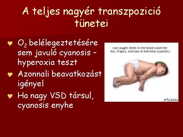A teljes nagyér transzpozició tünetei O 2 belélegeztetésére sem javuló cyanosis – hyperoxia teszt