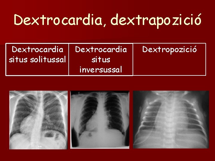 Dextrocardia, dextrapozició Dextrocardia situs solitussal Dextrocardia situs inversussal Dextropozició 