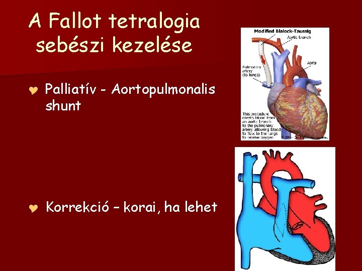 A Fallot tetralogia sebészi kezelése Y Y Palliatív - Aortopulmonalis shunt Korrekció – korai,