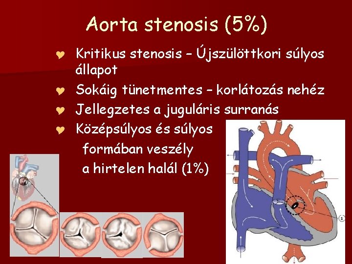 Aorta stenosis (5%) Kritikus stenosis – Újszülöttkori súlyos állapot Y Sokáig tünetmentes – korlátozás