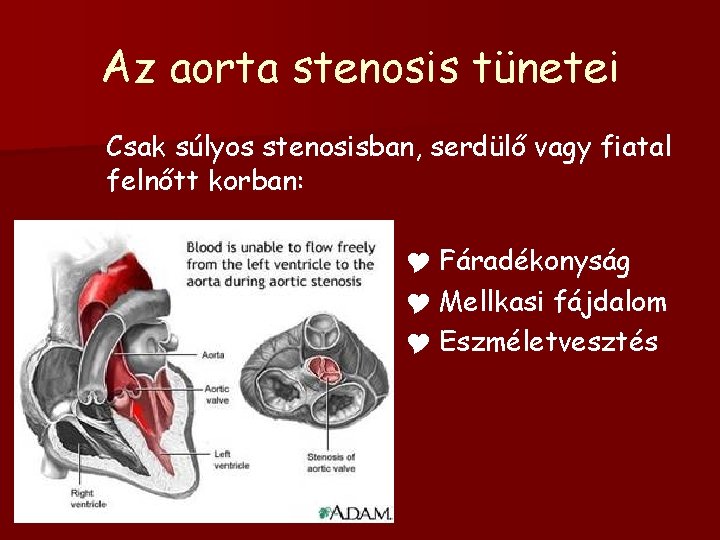 Az aorta stenosis tünetei Csak súlyos stenosisban, serdülő vagy fiatal felnőtt korban: Y Fáradékonyság