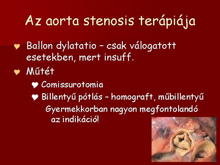 Az aorta stenosis terápiája Ballon dylatatio – csak válogatott esetekben, mert insuff. Y Műtét