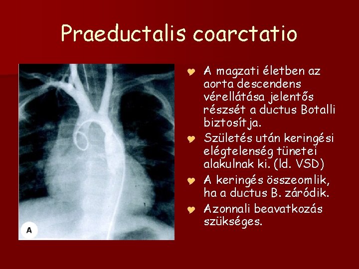 Praeductalis coarctatio A magzati életben az aorta descendens vérellátása jelentős részsét a ductus Botalli