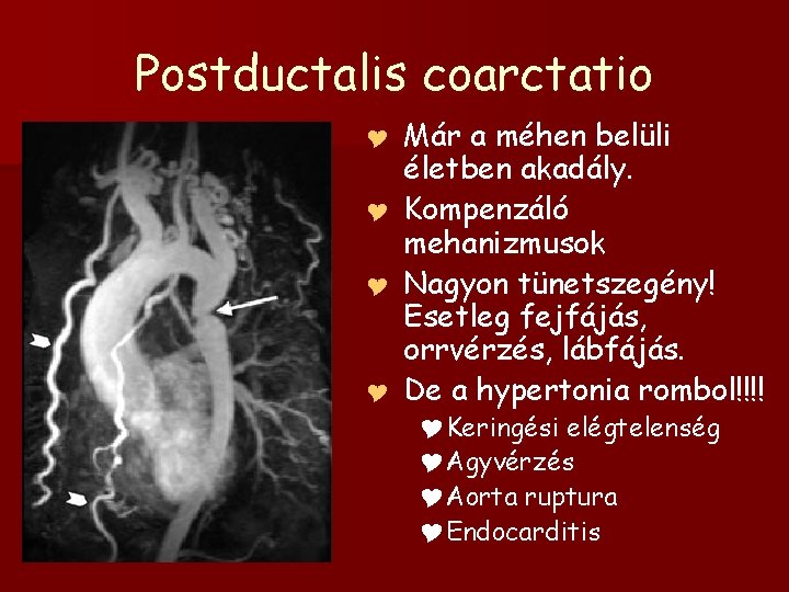 Postductalis coarctatio Y Y Már a méhen belüli életben akadály. Kompenzáló mehanizmusok Nagyon tünetszegény!