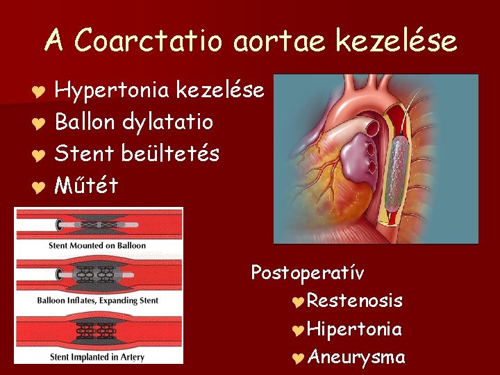 A Coarctatio aortae kezelése Hypertonia kezelése Y Ballon dylatatio Y Stent beültetés Y Műtét