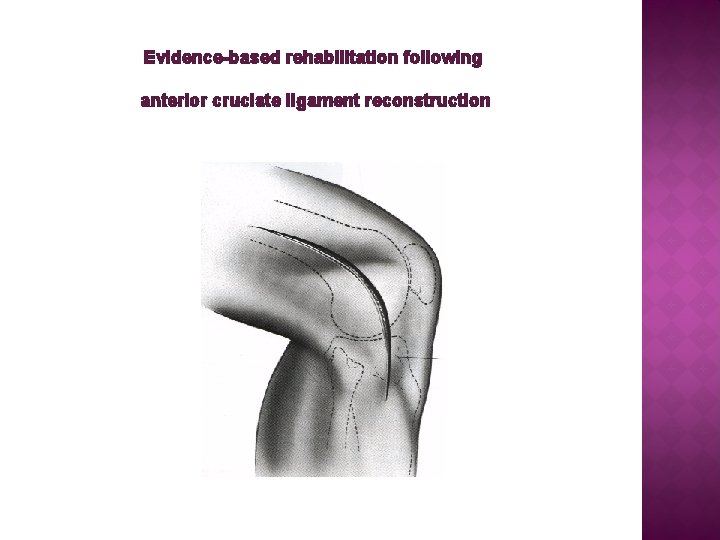 Evidence-based rehabilitation following anterior cruciate ligament reconstruction 