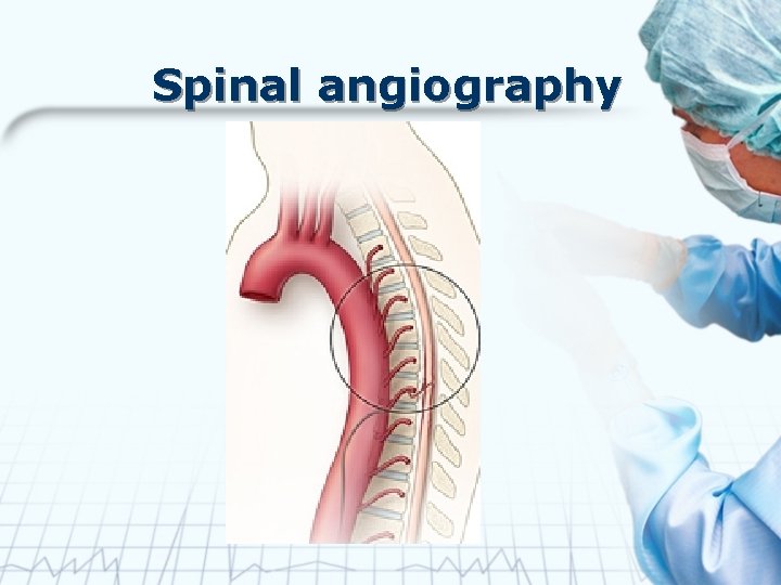 Spinal angiography 