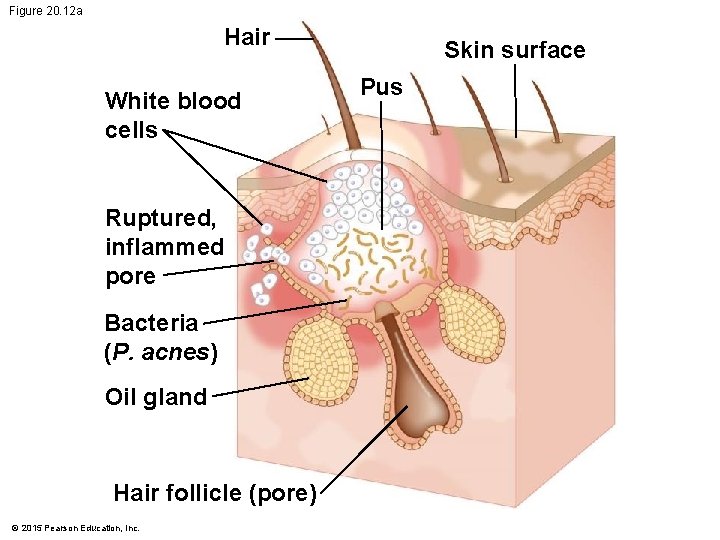 Figure 20. 12 a Hair White blood cells Ruptured, inflammed pore Bacteria (P. acnes) Figure 20. 12 a Hair White blood cells Ruptured, inflammed pore Bacteria (P. acnes)