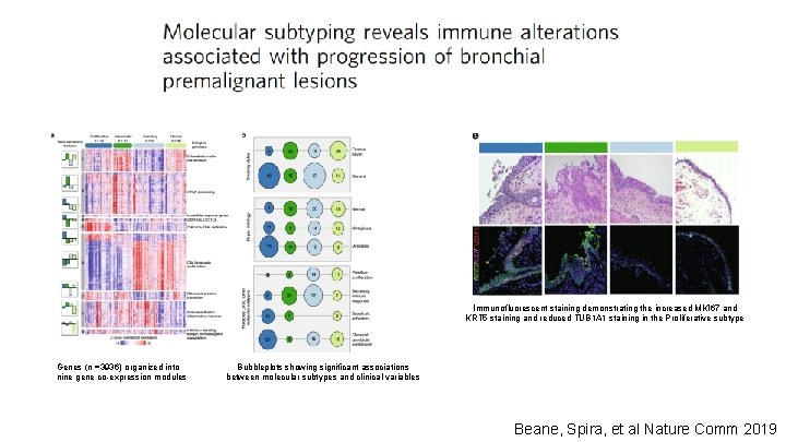 Immunofluorescent staining demonstrating the increased MKI 67 and KRT 5 staining and reduced TUB