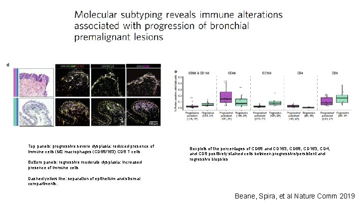 Top panels: progressive severe dysplasia: reduced presence of immune cells (M 2 macrophages (CD