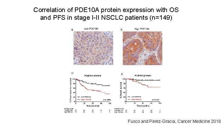 Correlation of PDE 10 A protein expression with OS and PFS in stage I-II