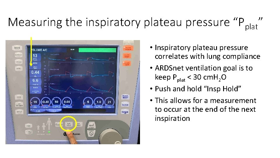 Measuring the inspiratory plateau pressure “Pplat” • Inspiratory plateau pressure correlates with lung compliance
