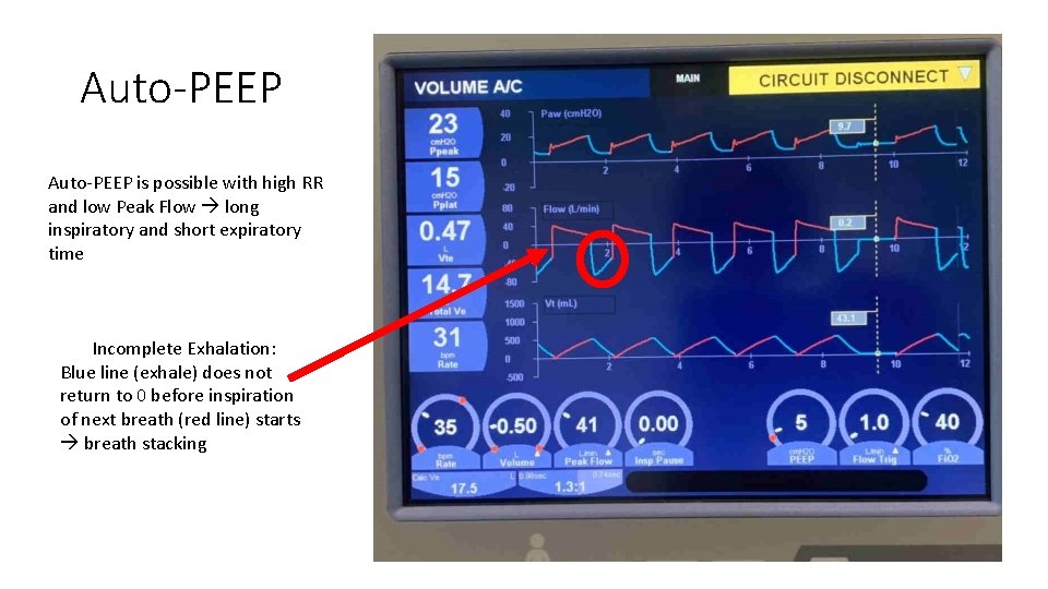 Auto-PEEP is possible with high RR and low Peak Flow long inspiratory and short
