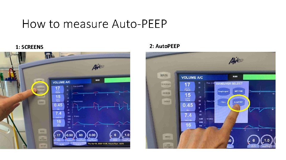 How to measure Auto-PEEP 1: SCREENS 2: Auto. PEEP 