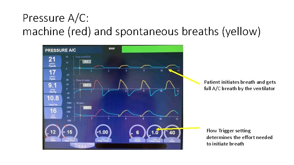 Pressure A/C: machine (red) and spontaneous breaths (yellow) Patient initiates breath and gets full