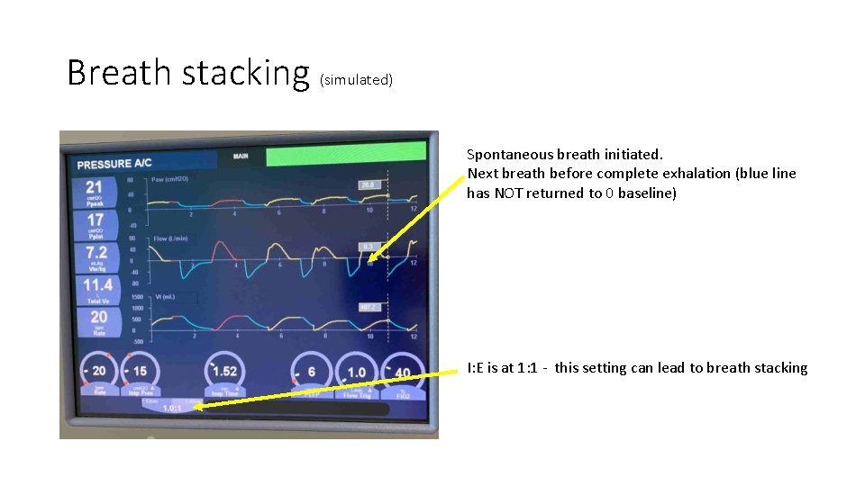 Breath stacking (simulated) Spontaneous breath initiated. Next breath before complete exhalation (blue line has