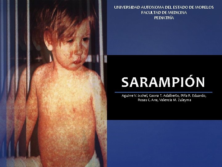 UNIVERSIDAD AUTONOMA DEL ESTADO DE MORELOS FACULTAD DE MEDICINA PEDIATRÍA SARAMPIÓN Aguirre V. Ixchel, UNIVERSIDAD AUTONOMA DEL ESTADO DE MORELOS FACULTAD DE MEDICINA PEDIATRÍA SARAMPIÓN Aguirre V. Ixchel,