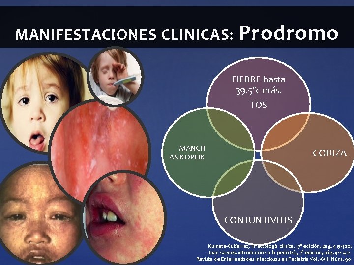 MANIFESTACIONES CLINICAS: Prodromo FIEBRE hasta 39. 5ºc más. TOS MANCH AS KOPLIK CORIZA CONJUNTIVITIS MANIFESTACIONES CLINICAS: Prodromo FIEBRE hasta 39. 5ºc más. TOS MANCH AS KOPLIK CORIZA CONJUNTIVITIS
