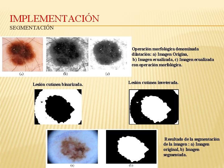 IMPLEMENTACIÓN SEGMENTACIÓN Operación morfológica denominada dilatación: a) Imagen Origina, b) Imagen ecualizada, c) Imagen