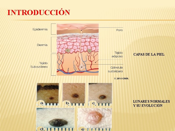 INTRODUCCIÓN CAPAS DE LA PIEL LUNARES NORMALES Y SU EVOLUCIÓN 