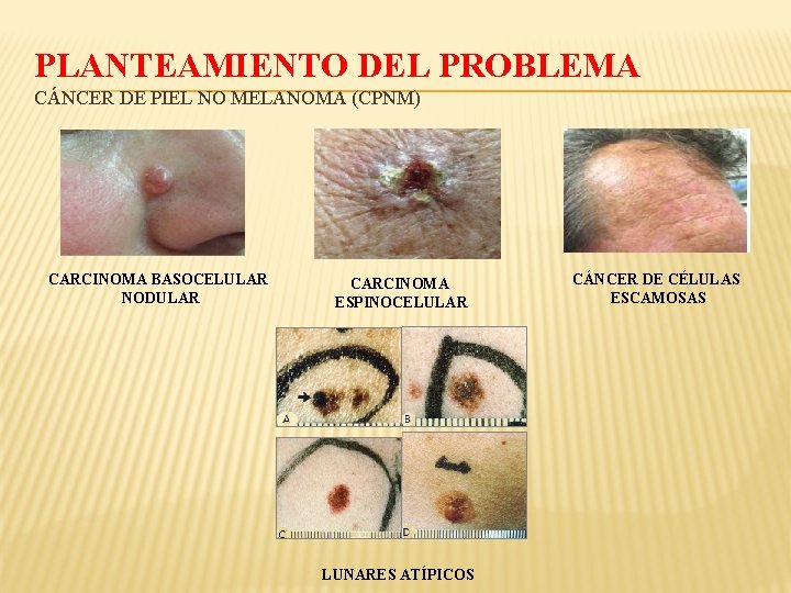 PLANTEAMIENTO DEL PROBLEMA CÁNCER DE PIEL NO MELANOMA (CPNM) CARCINOMA BASOCELULAR NODULAR CARCINOMA ESPINOCELULAR