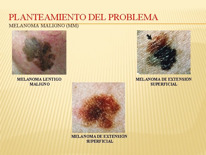 PLANTEAMIENTO DEL PROBLEMA MELANOMA MALIGNO (MM) MELANOMA LENTIGO MALIGNO MELANOMA DE EXTENSIÓN SUPERFICIAL 