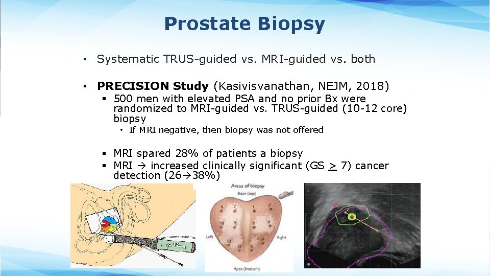 Prostate Biopsy • Systematic TRUS-guided vs. MRI-guided vs. both • PRECISION Study (Kasivisvanathan, NEJM, Prostate Biopsy • Systematic TRUS-guided vs. MRI-guided vs. both • PRECISION Study (Kasivisvanathan, NEJM,