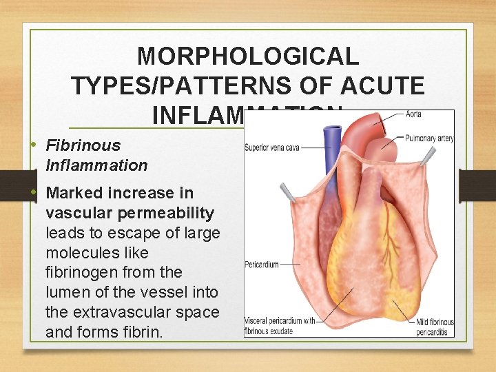 MORPHOLOGICAL TYPES/PATTERNS OF ACUTE INFLAMMATION • Fibrinous Inflammation • Marked increase in vascular permeability