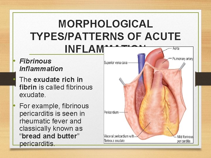 MORPHOLOGICAL TYPES/PATTERNS OF ACUTE INFLAMMATION • Fibrinous Inflammation • The exudate rich in fibrin